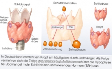 Goiter (goiter, enlarged thyroid)