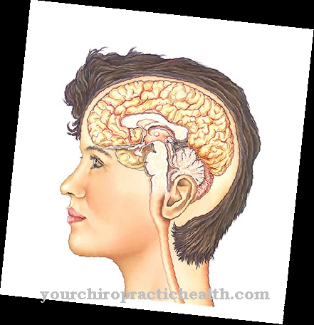 Subarachnoid hemorrhage