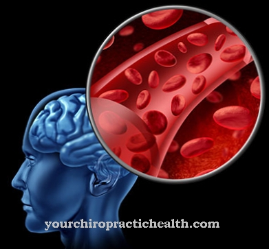 Hematom subdural