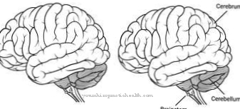 Subcortical arteriosclerotic encephalopathy