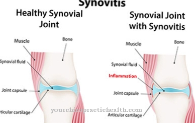 synovitis