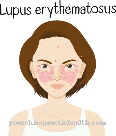 Bệnh lupus ban đỏ hệ thống (SLE)