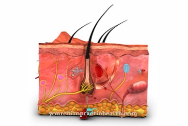 Telangiectasia