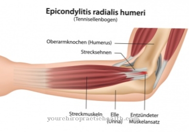 Tennis elbow