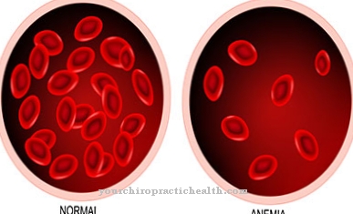 talassemia