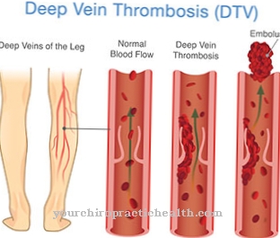 Thromboembolism