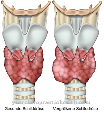 Thyrotoxic crisis