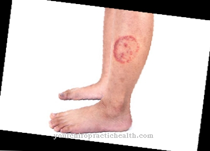 Tinea (dermatophytosis)