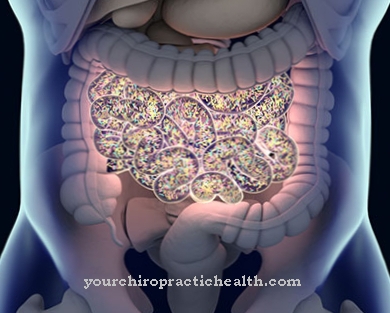 Toxic megacolon