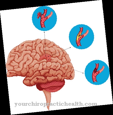 Transient ischemic attack