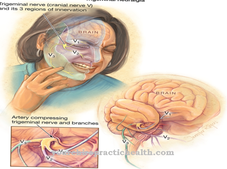 Trigeminal neuralgia