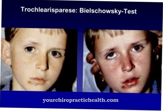 Trochlear palsy