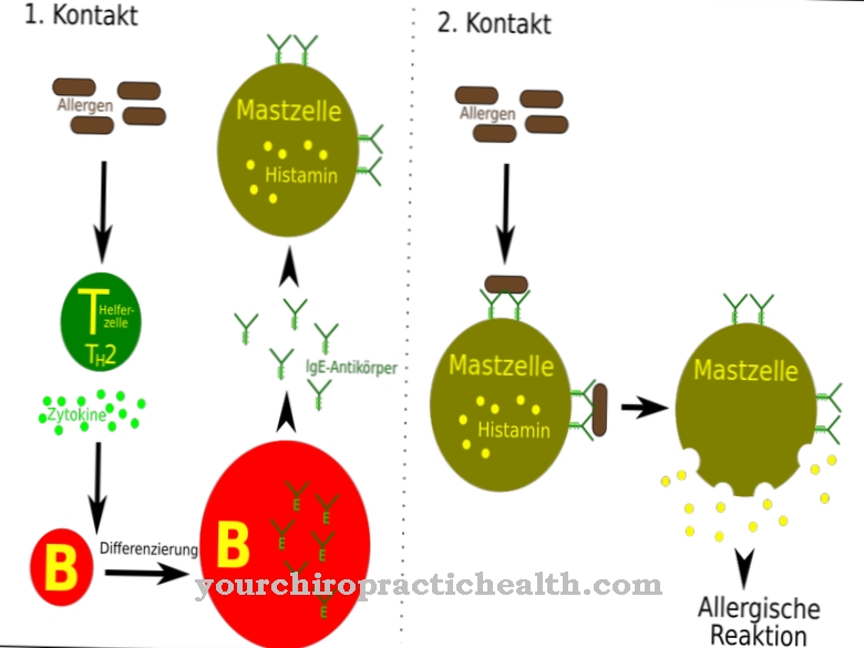 Type I allergy