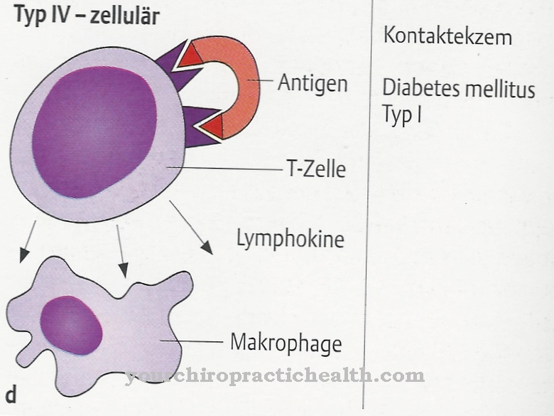 Type IV allergy