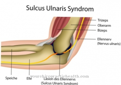 Sindrom Ulnar Channel