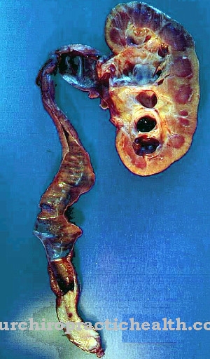 Ureteraal carcinoom