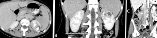 Urogenital tuberculosis