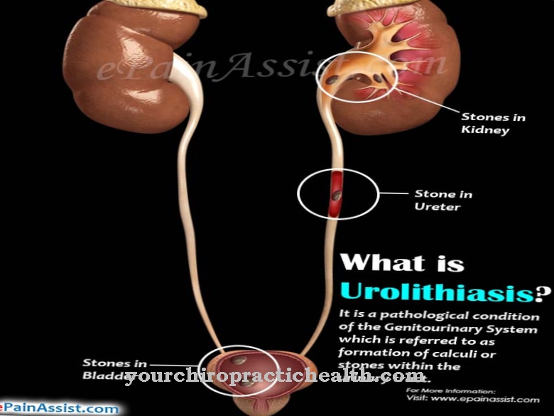 urolithiasis