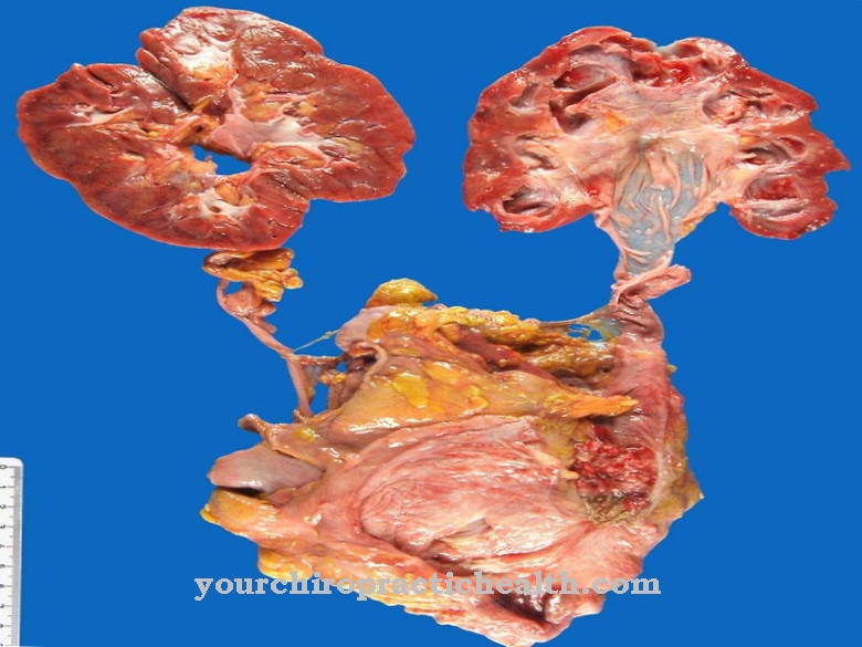 Urothelial carcinoma