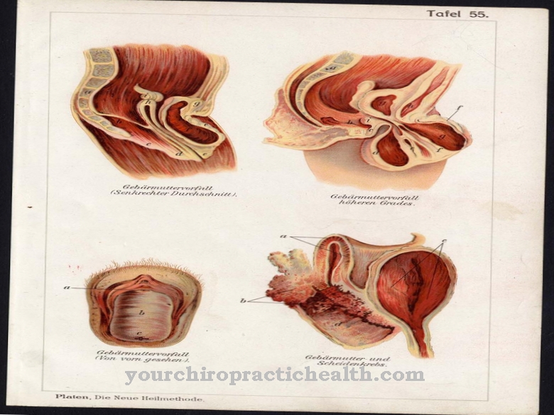 Uterine prolapse