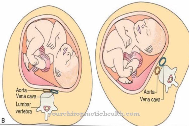 Sindromul de compresie Vena cava