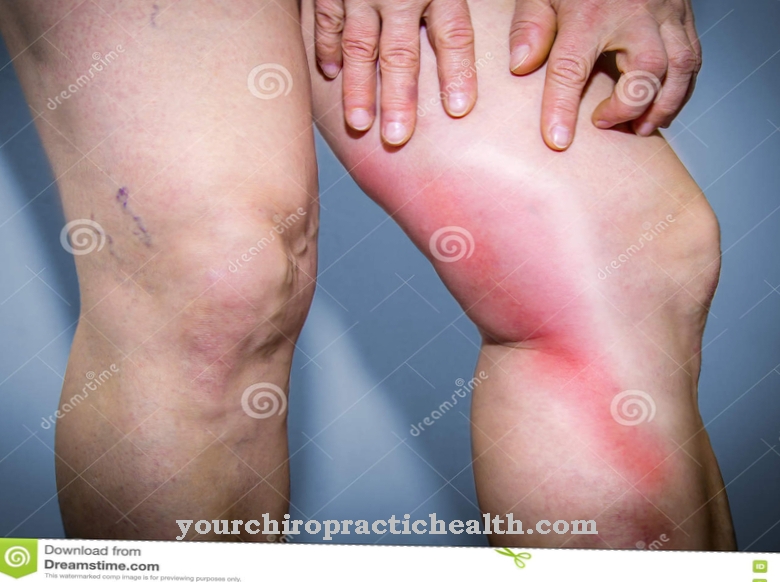 phlebitis