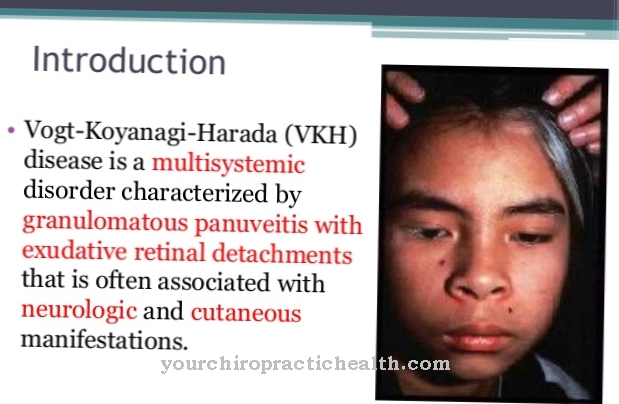 Vogt-Koyanagi-Harada syndrome