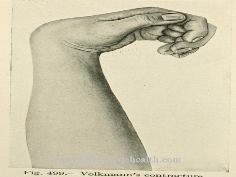 Volkmann contracture