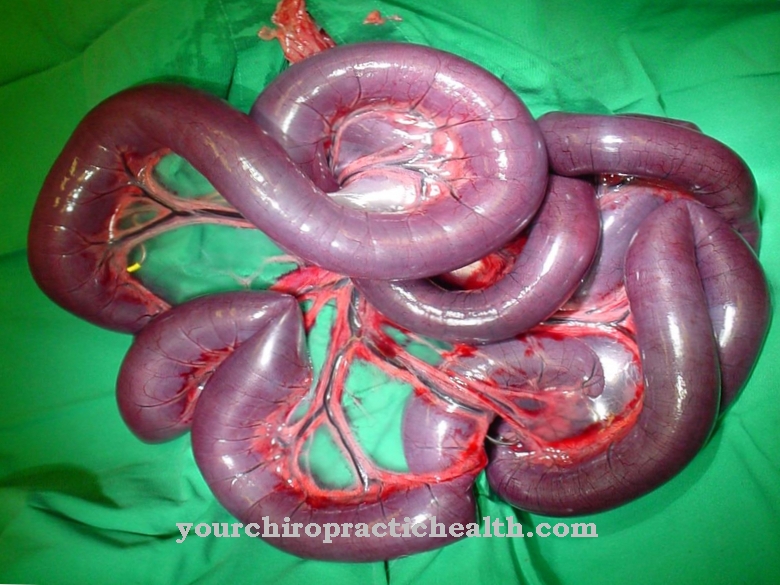 Volvulus (obstrucție intestinală)