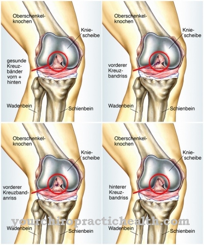 Desgarro del ligamento cruzado anterior