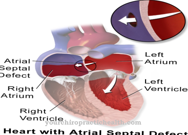 Atrial septal defect