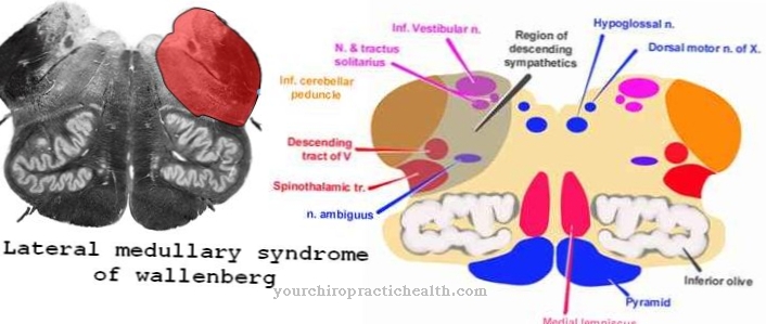 Wallenberg syndrome