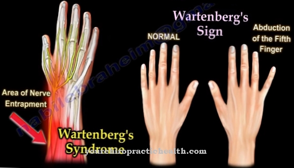 Wartenberg syndrome