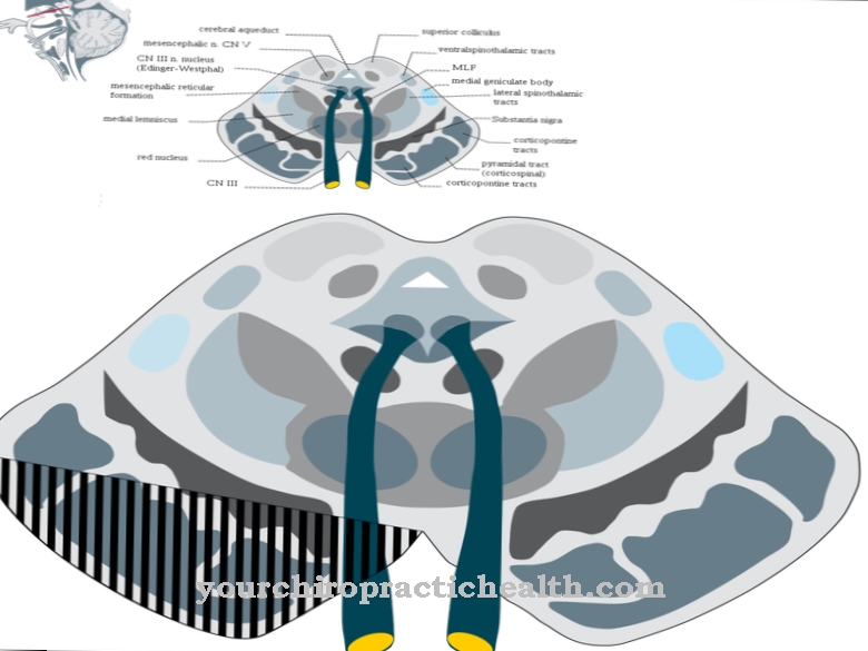 Weber syndrome