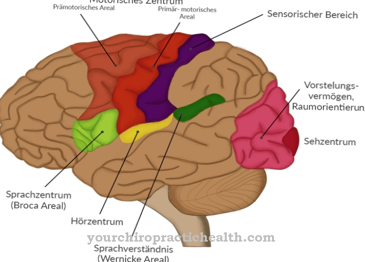 Wernicke aphasia