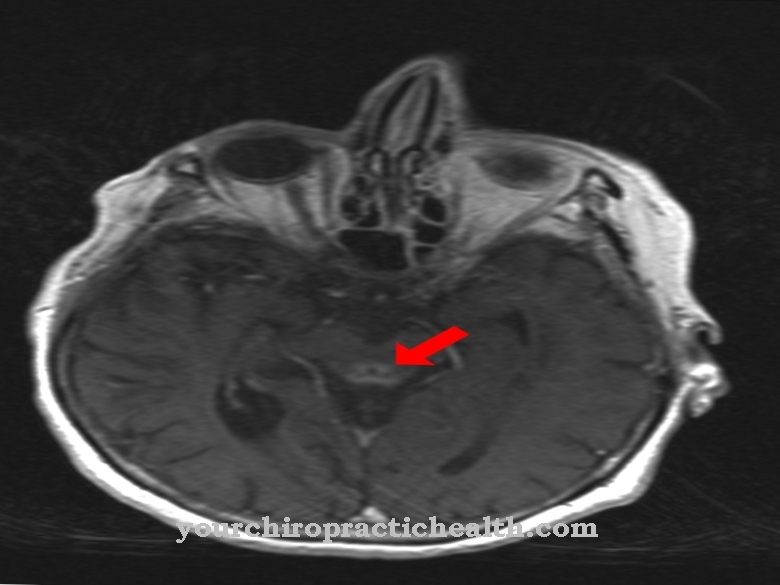 Wernicke encephalopathy