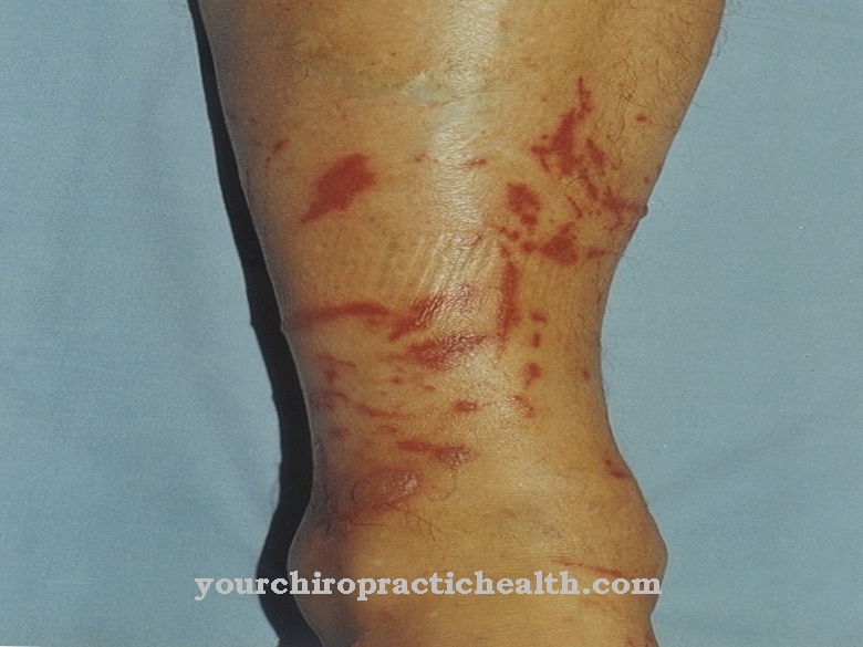 Weidegrasdermatitis