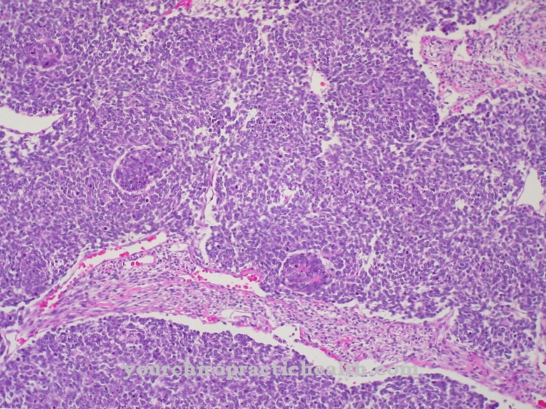 Wilms tümörü (nefroblastoma)