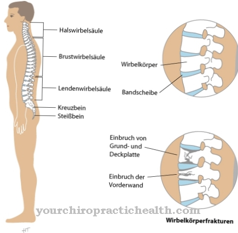 Frattura del corpo vertebrale (frattura del corpo vertebrale)