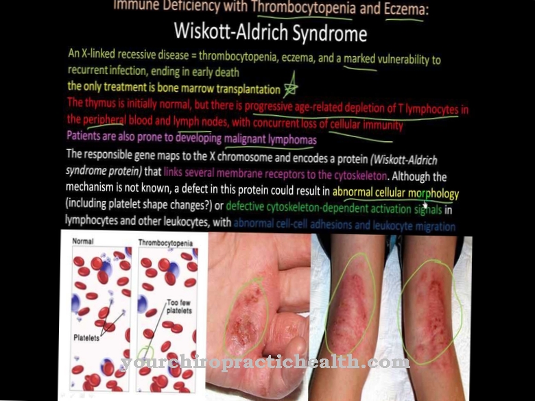 Syndrome de Wiskott-Aldrich