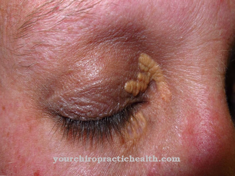 xanthelasma