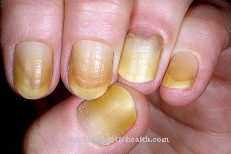 Yellow nail syndrome