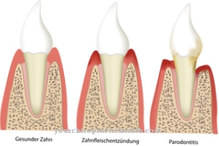 Inflammation of the gums