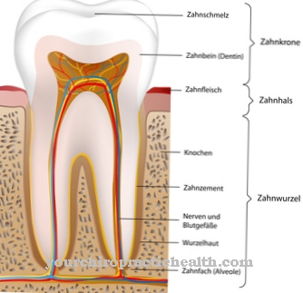 Tooth fracture