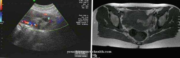 Cervical dystocia