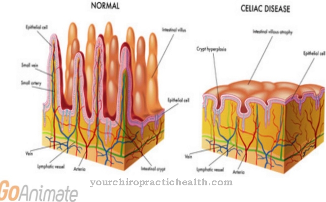 Celiac disease (gluten intolerance)