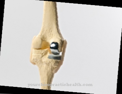 Knee prosthesis