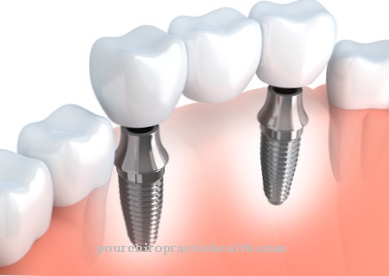 Dental implant