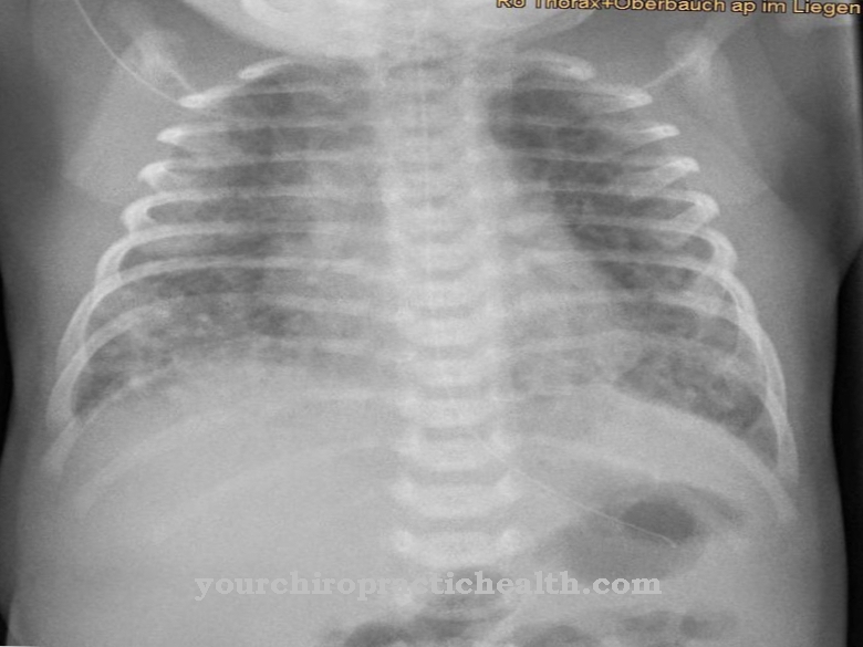 Newborn Respiratory Distress Syndrome (ANS)