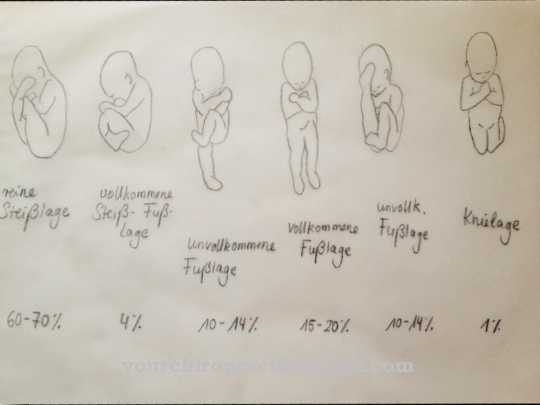 Breech position (breech position)